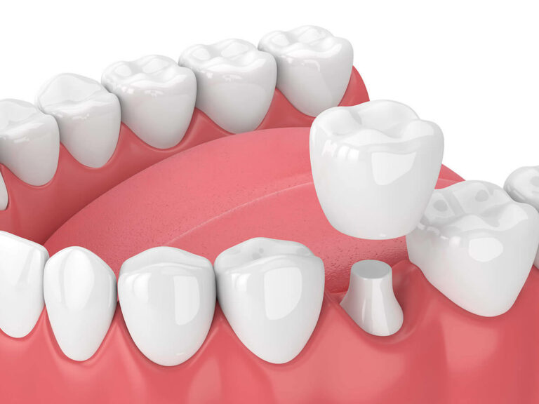Same-day dental crowns at CambridgePort Dental