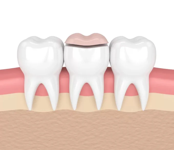 Dental Inlays and Onlays