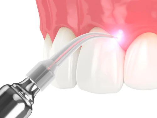 Soft Tissue Dental Laser in Cambridge, MA at CambridgePort, MA